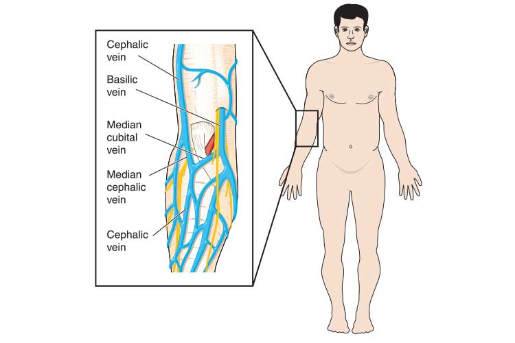 Managing Difficult IV Cannulation | Ausmed