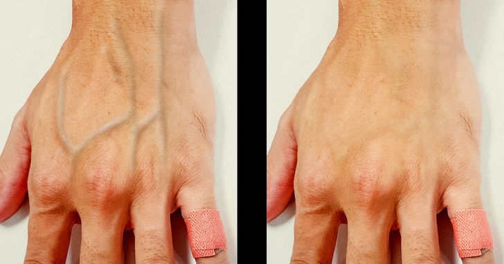 Why Do Some People's Veins Appear Through Their Skin?